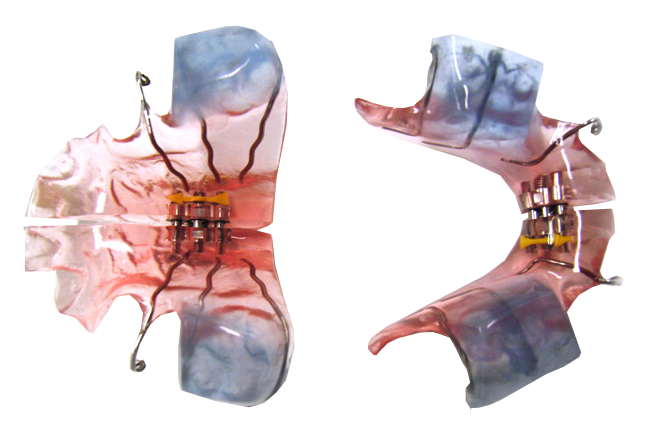 Ортодонтические аппараты