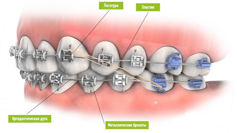 Брекет-система 