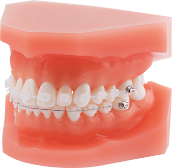 Брекеты лигатурные керамические Discovery pearl Roth 022 кр.3,4,5, 20 шт. фото в интернет-магазине Дентаурум